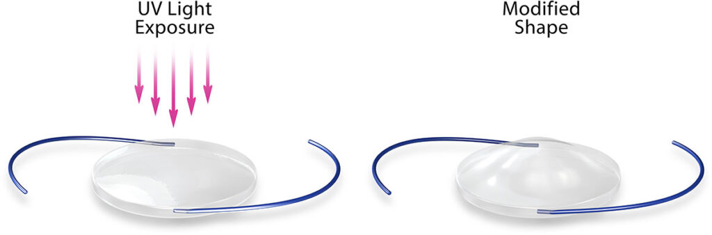RxSights™ Light Adjustable Lens by RxSight